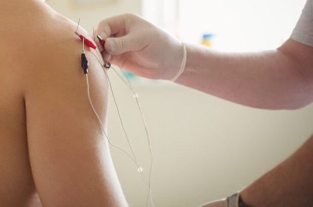 درای نیدلینگ (Dry Needling)